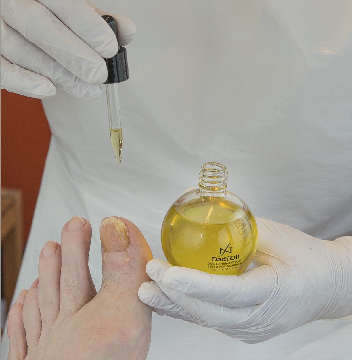 Verzorgende nagelolie wordt met een pipet op een verdikte teennagel aangebracht