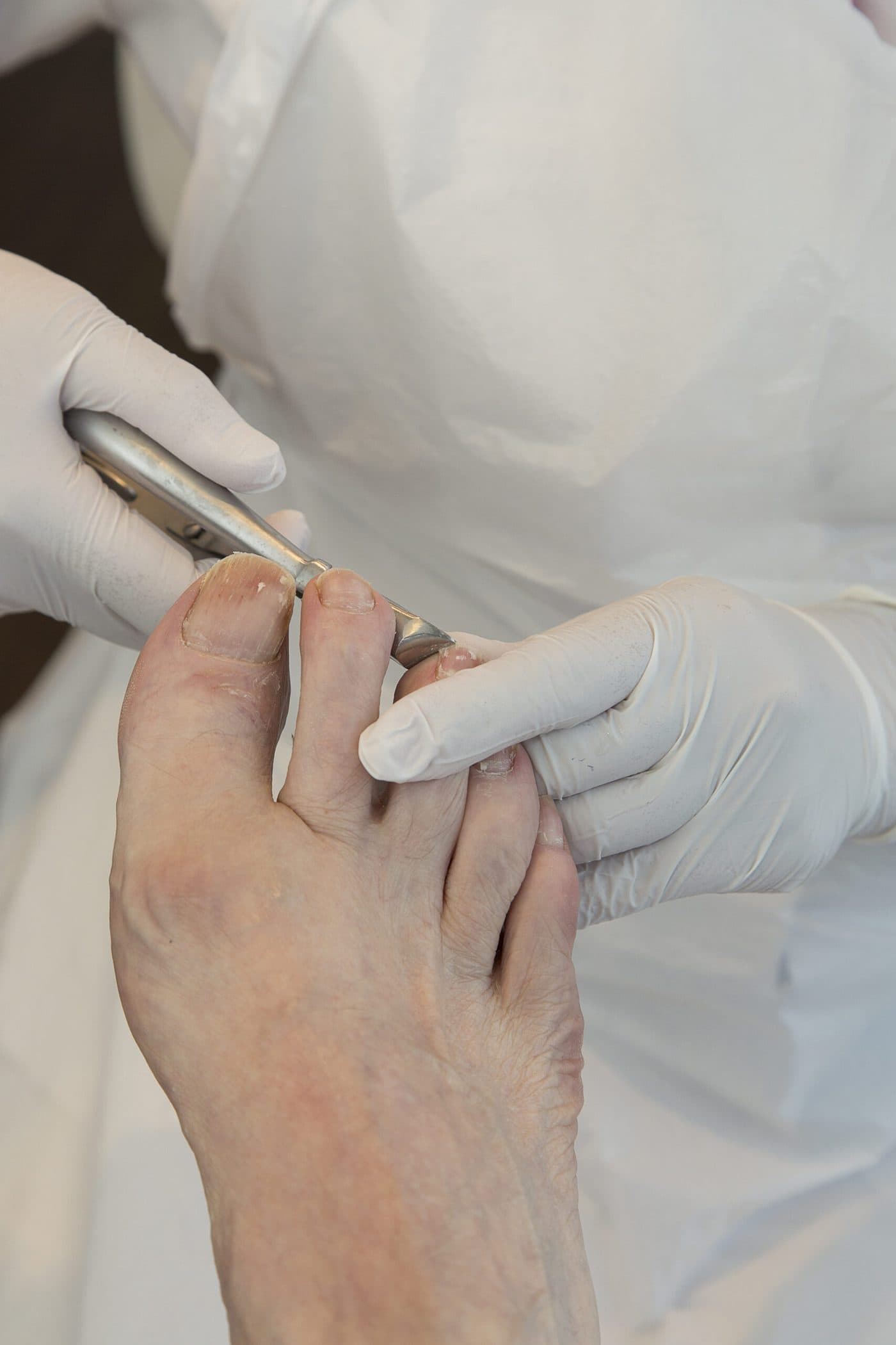 Medisch pedicure knipt met handschoenen en nageltang een teennagel